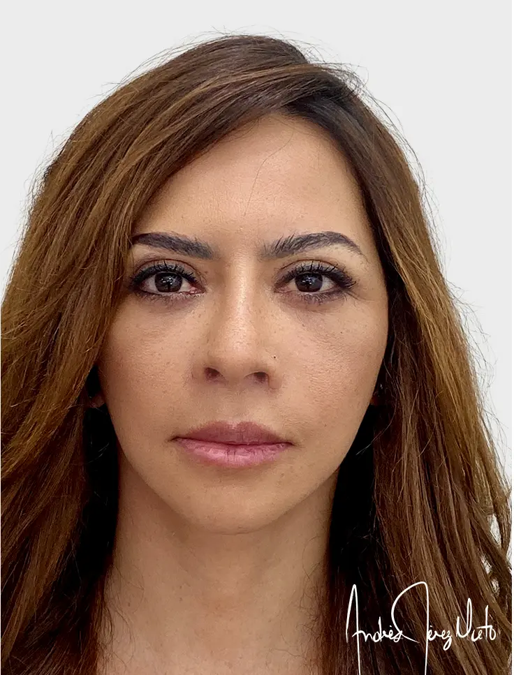 paciente 1 - Después